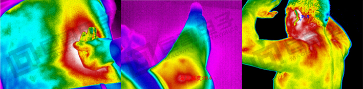 巨哥电子-热成像仪辅助评价治疗效果